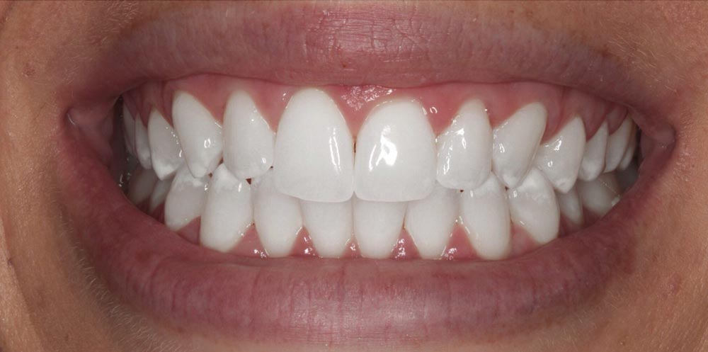 After-teeth-bleaching