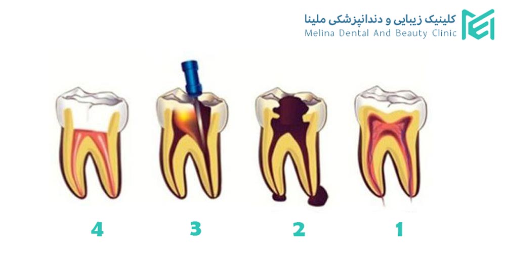 درمان ریشه و عصب کشی در کلینیک ملینا