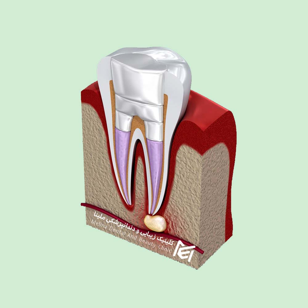 علائم درمان ریشه فاطمی