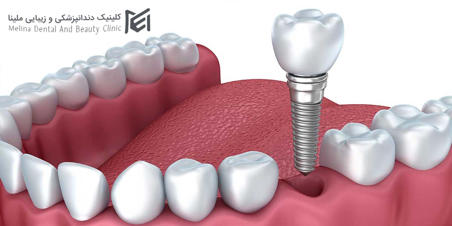 ایمپلنت اقساطی در فاطمی