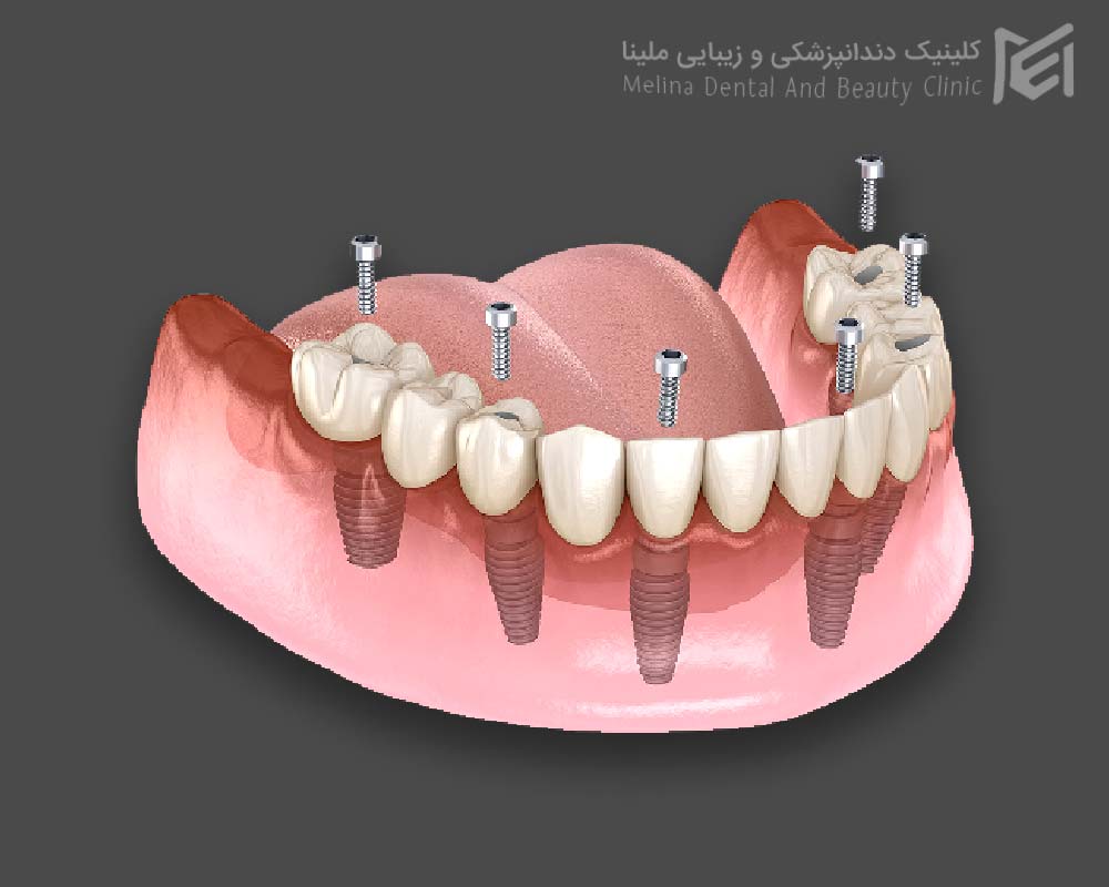 ایمپلنت اقساطی