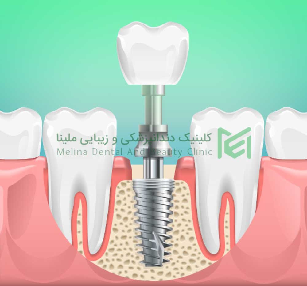 محدودیت های ایمپلنت اقساطی