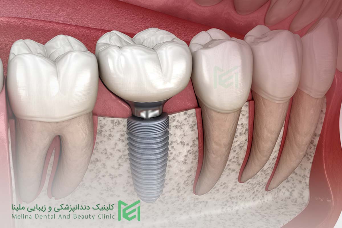 انتخاب بهترین زمان ایمپلنت دندان