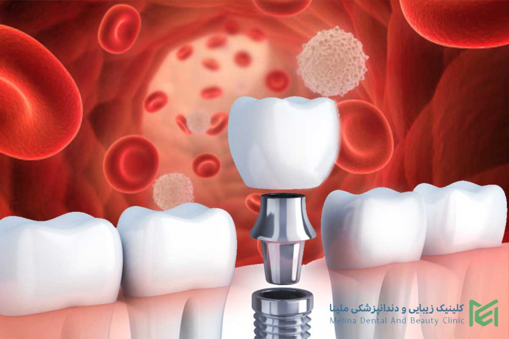 ممنوعیت ایمپلنت دندان برای بیماران لوسمی