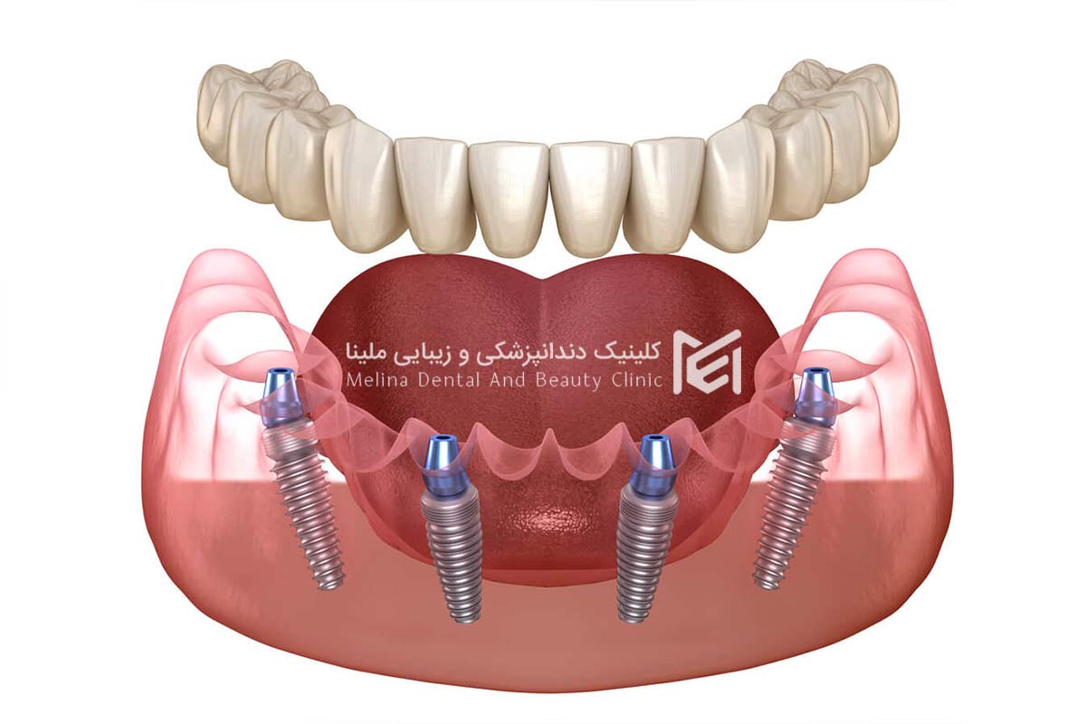 عوامل موثر طول عمر ایمپلنت