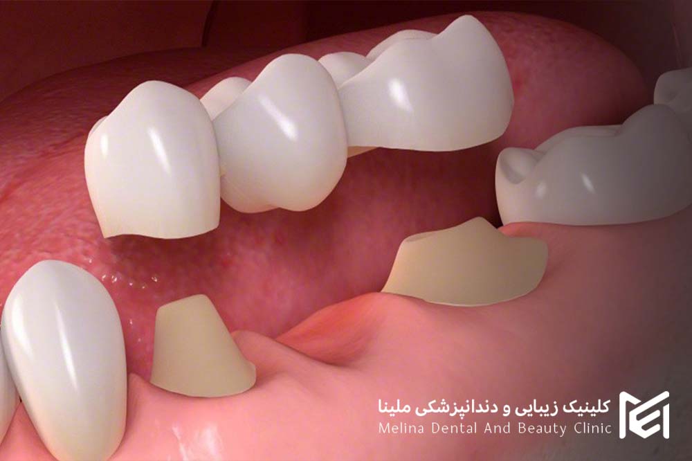 پر کردن دندان با بریج مری لند